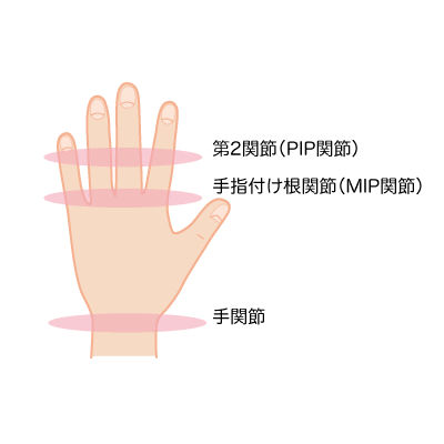 第2関節（PIP関節）・手指付け根関節（MIP関節）・手関節を表すイラスト
